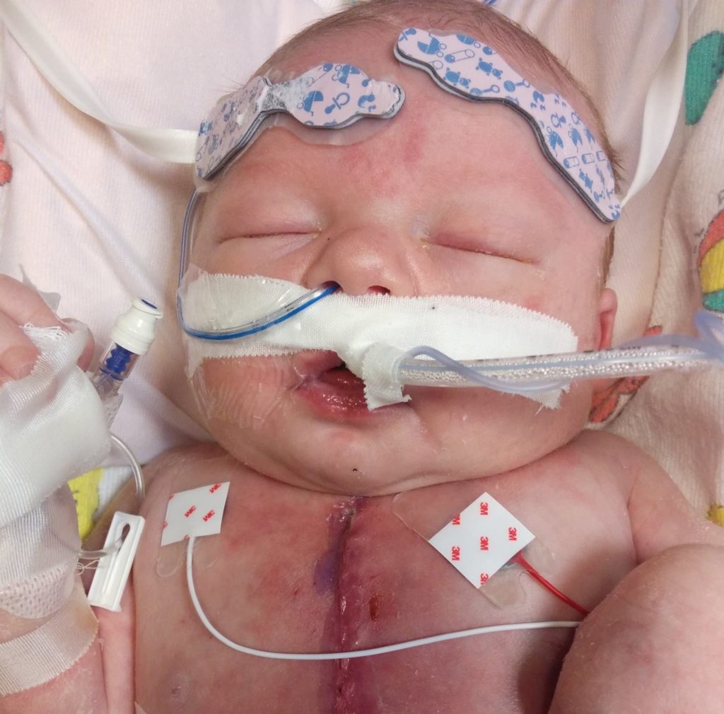 Newborn baby just a few hours after heart surgeon finished his surgery.