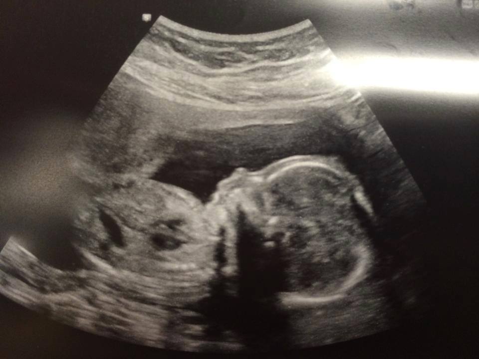 Profile of a baby at the 20 week anatomy ultrasound.