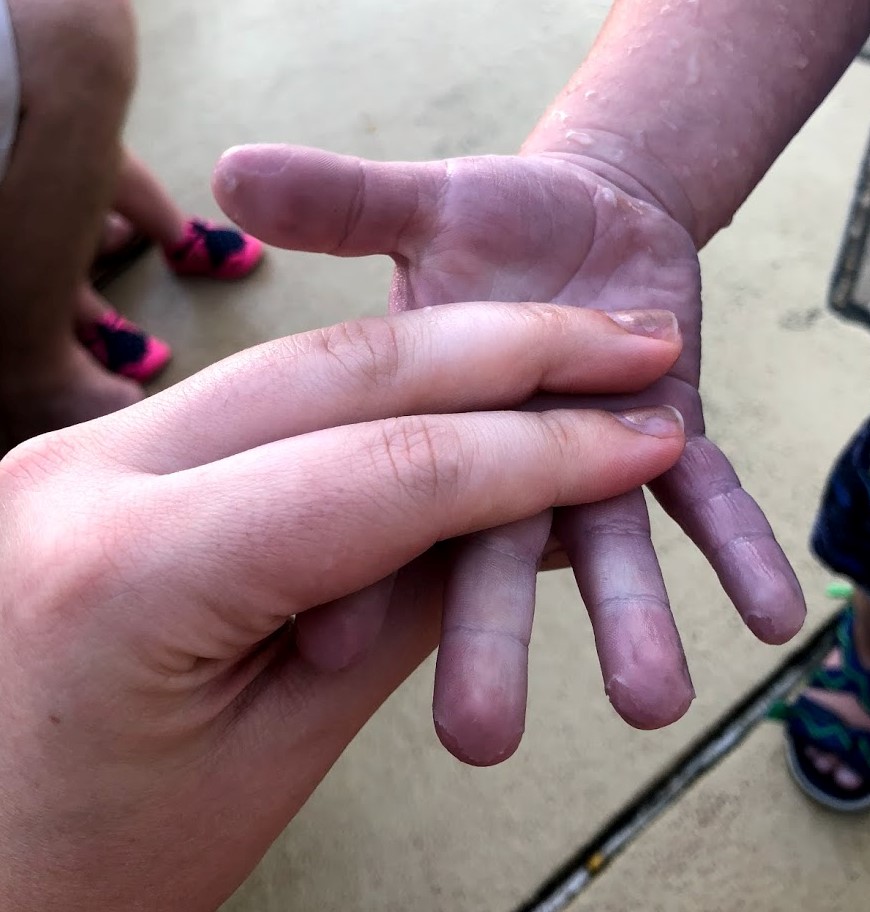 Toddler's hand looking blue while swimming at the pool before Fontan heart surgery.