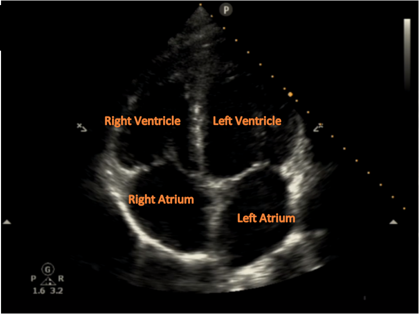 An ultrasound image of the heart with all 4 chambers visible.