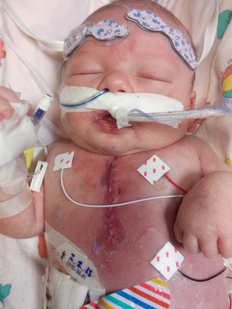 Newborn baby after Norwood surgery for his heart defect.