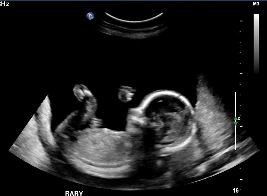 Ultrasound image of a baby diagnosed with CHD. 